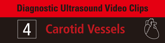 Diagnostic Ultrasound Video Clips 4- Carotid Vessels